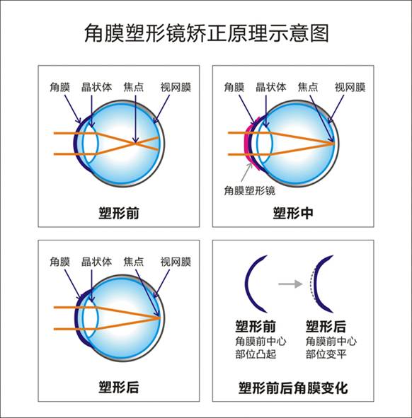 在睡梦中摘掉眼镜—角膜塑形镜