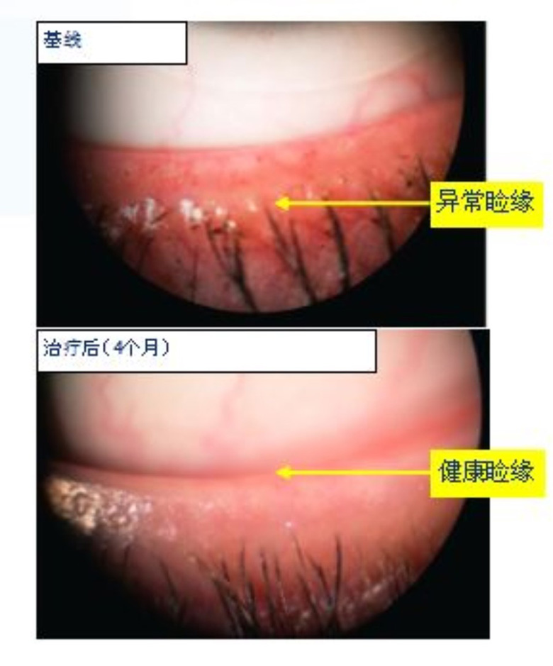 5,恢复局部低氧环境 正常情况下,睑板腺细胞处于低氧环境,而炎症时