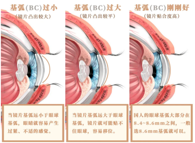 网上商城 摘戴不规范 眼底泪两行 喜欢隐形眼镜的小姐姐务必全文背诵 兴齐眼科医院